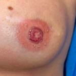 Tatouage de l'areole apres mastectomie.png